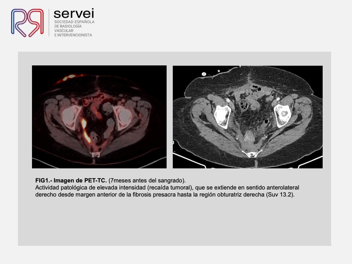 Pseudoaneurisma arteria obturatriz-rectorragia 03