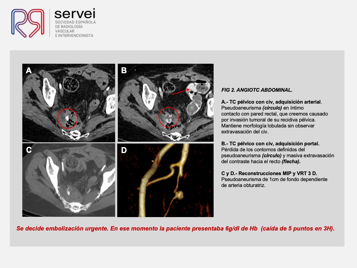 Pseudoaneurisma arteria obturatriz-rectorragia 04