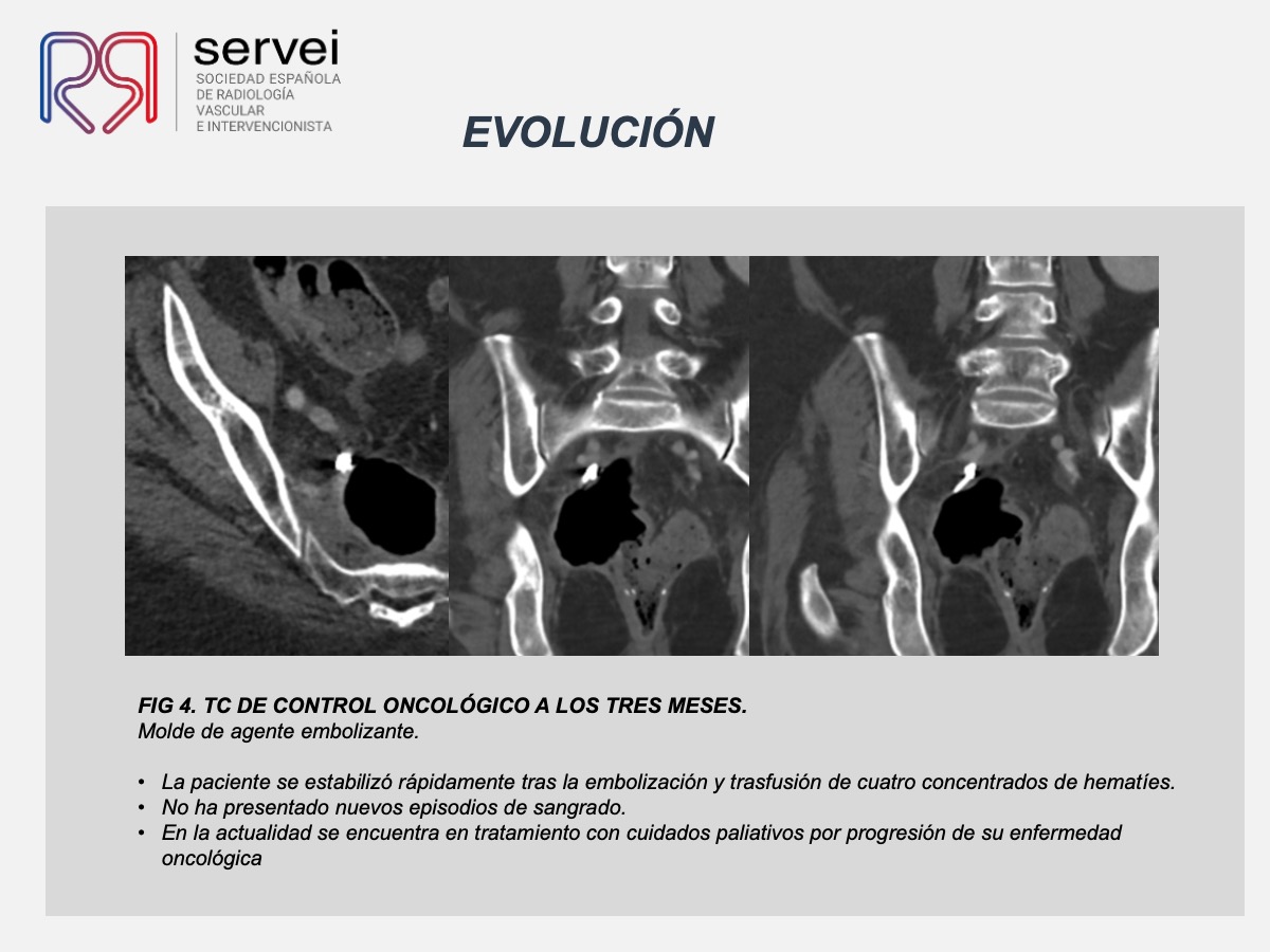 Pseudoaneurisma arteria obturatriz-rectorragia 06