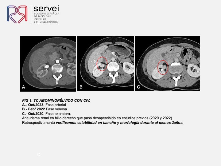 Aneurisma renal con dispositivo derivador flujo 03