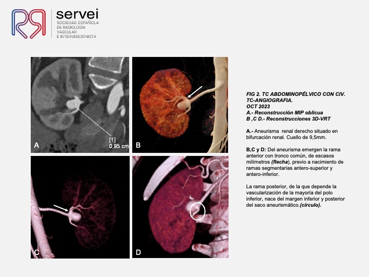 Aneurisma renal con dispositivo derivador flujo 04