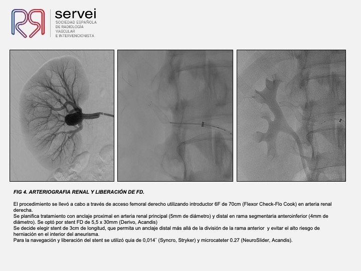 Aneurisma renal con dispositivo derivador flujo 06
