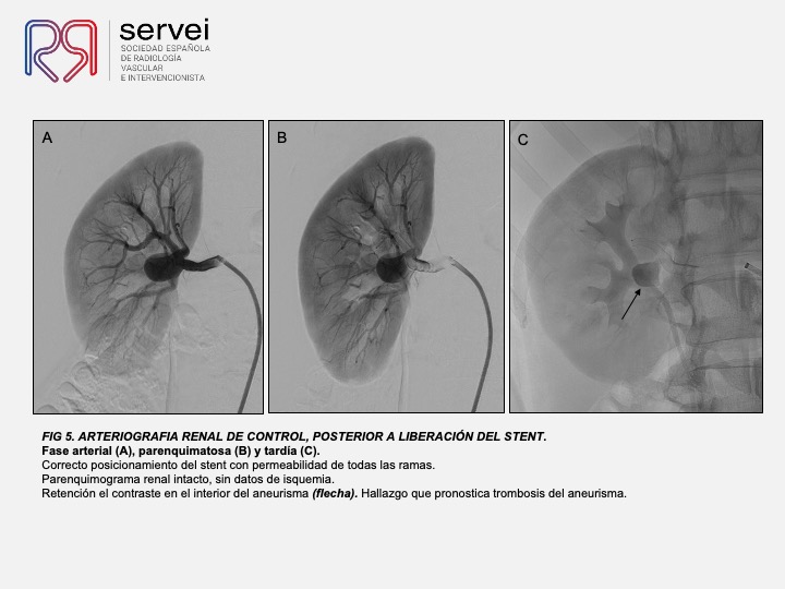 Aneurisma renal con dispositivo derivador flujo 07