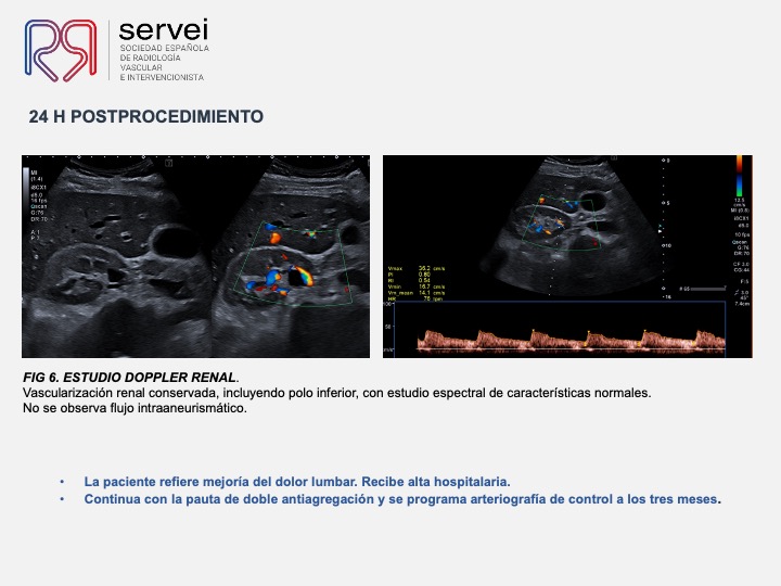 Aneurisma renal con dispositivo derivador flujo 08