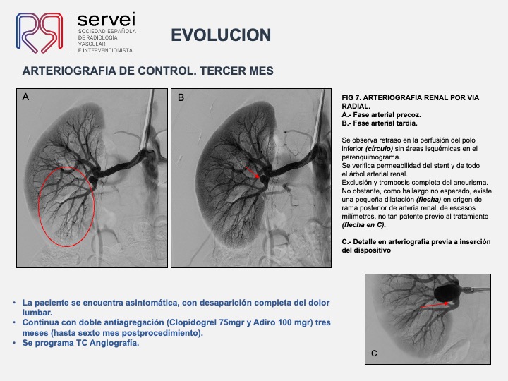 Aneurisma renal con dispositivo derivador flujo 09