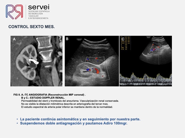Aneurisma renal con dispositivo derivador flujo 10