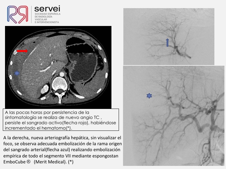 05 Hemorragia hepatica postbiopsia-embolizacion con Onyx