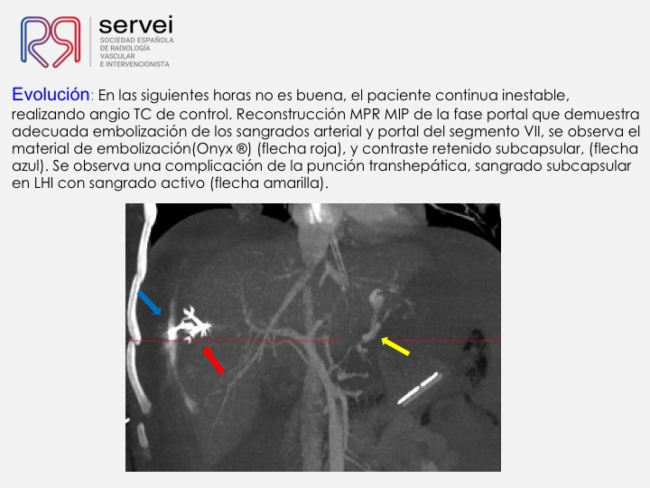 08 Hemorragia hepatica postbiopsia-embolizacion con Onyx