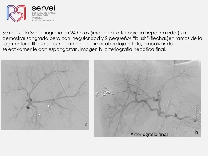 09 Hemorragia hepatica postbiopsia-embolizacion con Onyx