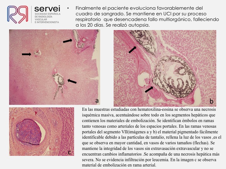 10  Hemorragia hepatica postbiopsia-embolizacion con Onyx